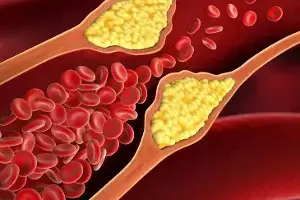 High Cholesterol: కనిపించని శత్రువు హై కొలెస్ట్రాల్: ఈ లక్షణాలను అస్సలు వదిలేయకండి! High Cholesterol: కనిపించని శత్రువు హై కొలెస్ట్రాల్: ఈ లక్షణాలను అస్సలు వదిలేయకండి!