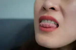 Troubled by Tongue Ulcers: నాలుకపై పుండ్లు వేధిస్తున్నాయా? ఈ చిట్కాలతో చెక్ పెట్టండి..