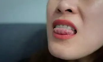 Troubled by Tongue Ulcers: నాలుకపై పుండ్లు వేధిస్తున్నాయా? ఈ చిట్కాలతో చెక్ పెట్టండి..