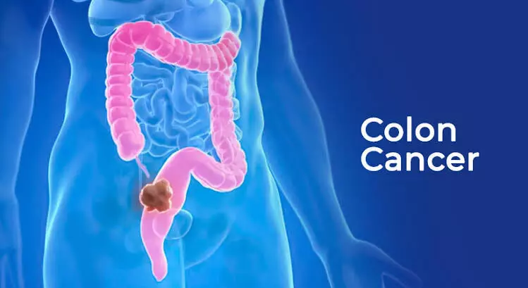 Colorectal Cancer: పెద్దప్రేగు క్యాన్సర్.. లక్షణాలు లేని సైలెంట్ కిల్లర్.. ఈ 5 మార్పులను అస్సలు నిర్లక్ష్యం చేయకండి.. Colorectal Cancer: పెద్దప్రేగు క్యాన్సర్.. లక్షణాలు లేని సైలెంట్ కిల్లర్.. ఈ 5 మార్పులను అస్సలు నిర్లక్ష్యం చేయకండి..