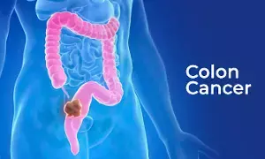 Colorectal Cancer: పెద్దప్రేగు క్యాన్సర్.. లక్షణాలు లేని సైలెంట్ కిల్లర్.. ఈ 5 మార్పులను అస్సలు నిర్లక్ష్యం చేయకండి.. Colorectal Cancer: పెద్దప్రేగు క్యాన్సర్.. లక్షణాలు లేని సైలెంట్ కిల్లర్.. ఈ 5 మార్పులను అస్సలు నిర్లక్ష్యం చేయకండి..