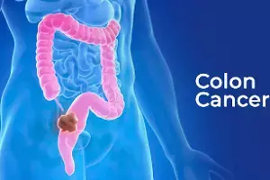 Colorectal Cancer: పెద్దప్రేగు క్యాన్సర్.. లక్షణాలు లేని సైలెంట్ కిల్లర్.. ఈ 5 మార్పులను అస్సలు నిర్లక్ష్యం చేయకండి.. Colorectal Cancer: పెద్దప్రేగు క్యాన్సర్.. లక్షణాలు లేని సైలెంట్ కిల్లర్.. ఈ 5 మార్పులను అస్సలు నిర్లక్ష్యం చేయకండి..
