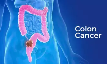 Colorectal Cancer: పెద్దప్రేగు క్యాన్సర్.. లక్షణాలు లేని సైలెంట్ కిల్లర్.. ఈ 5 మార్పులను అస్సలు నిర్లక్ష్యం చేయకండి..